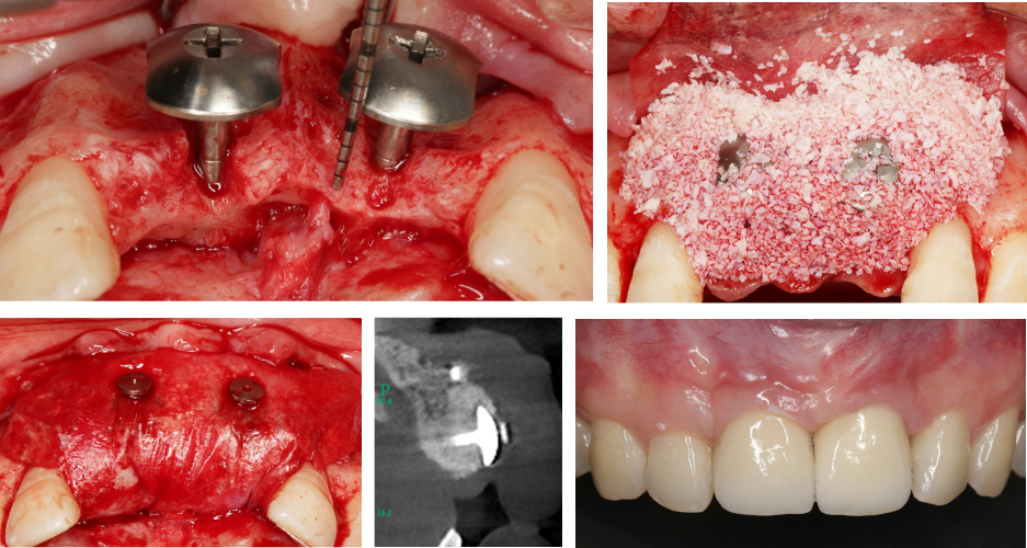 帐篷钉技术临床过程与修复效果