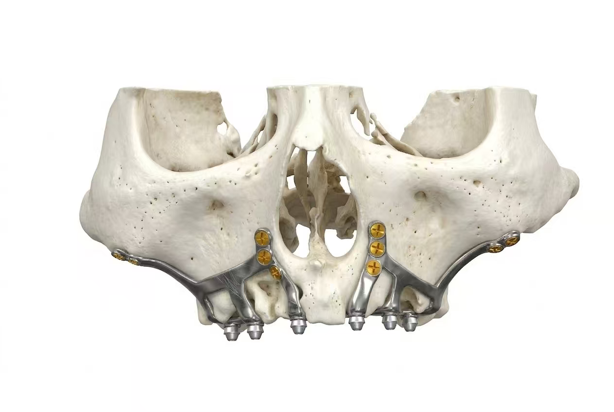 骨膜下种植体结构示意
