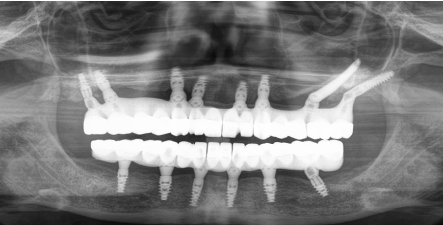 Pterygoid implant radiographic case